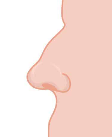 Rhinoplasty Myths