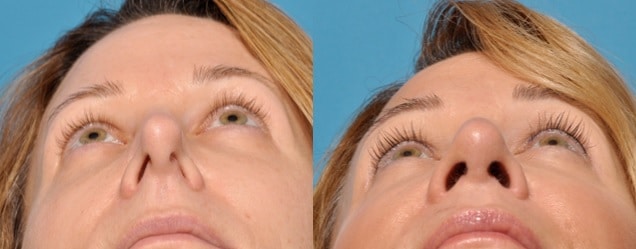 Do You Have A Deviated Septum Rejuva Medical Aesthetics