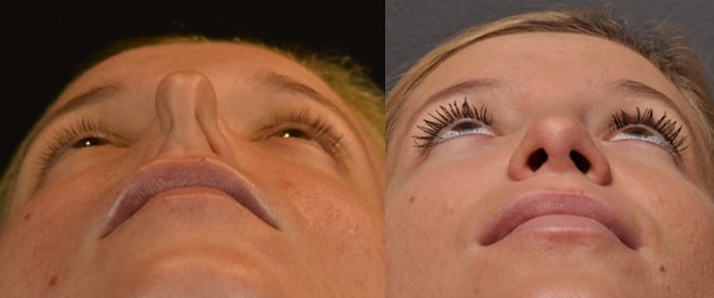 Rhinoplasty in Los Angeles, CA