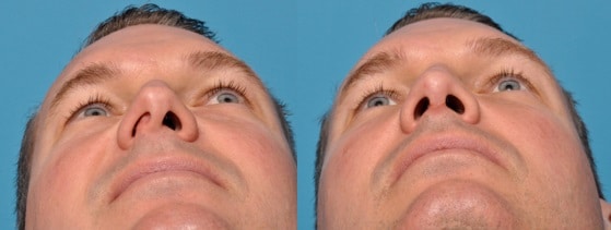 Rhinoplasty in Los Angeles, CA