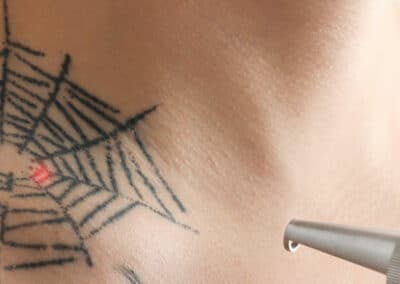 Top 5 Reasons Patients Need a Tattoo Removal Procedure