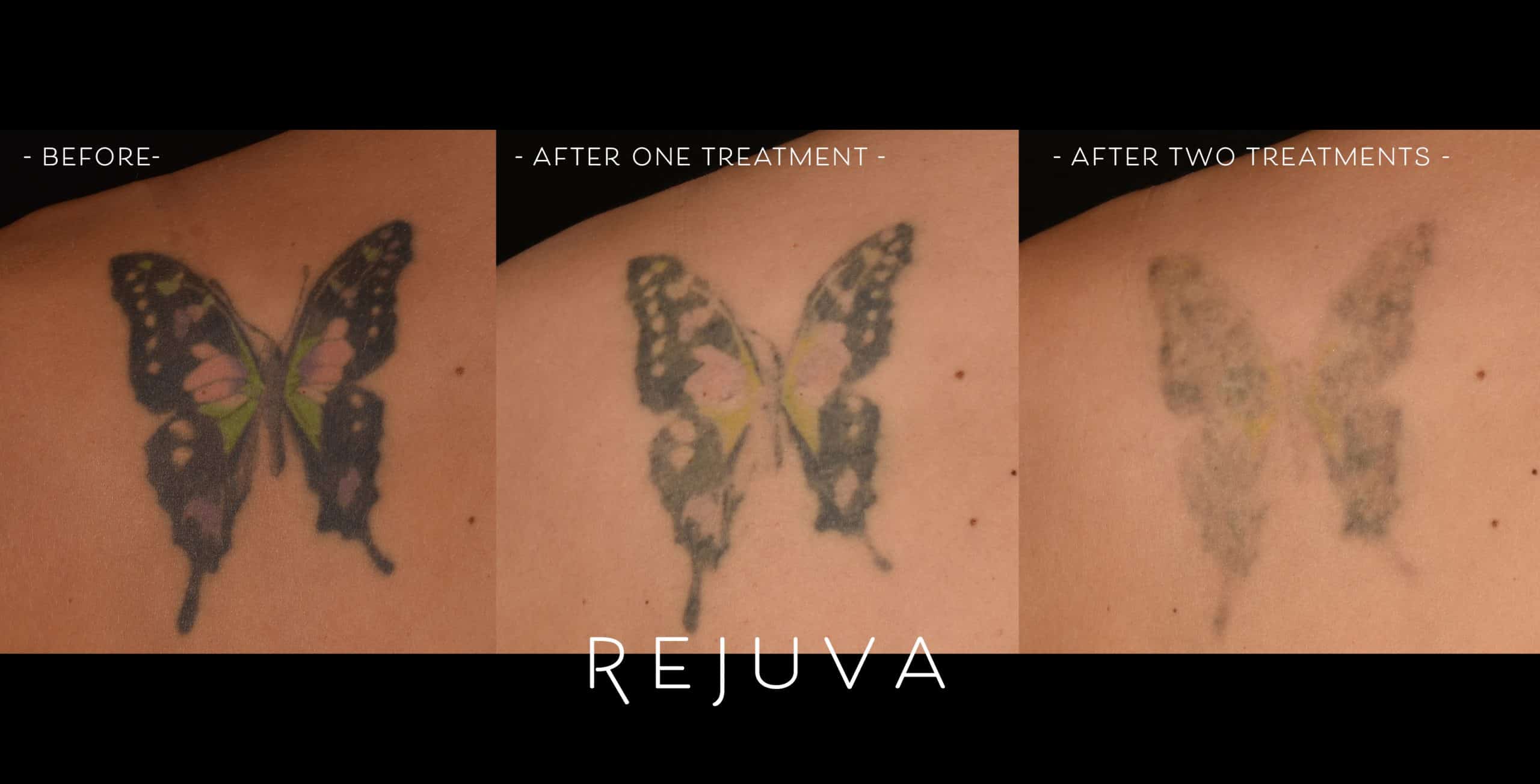 Laser Tattoo Removal in Valencia CA  Infinity Med Spa