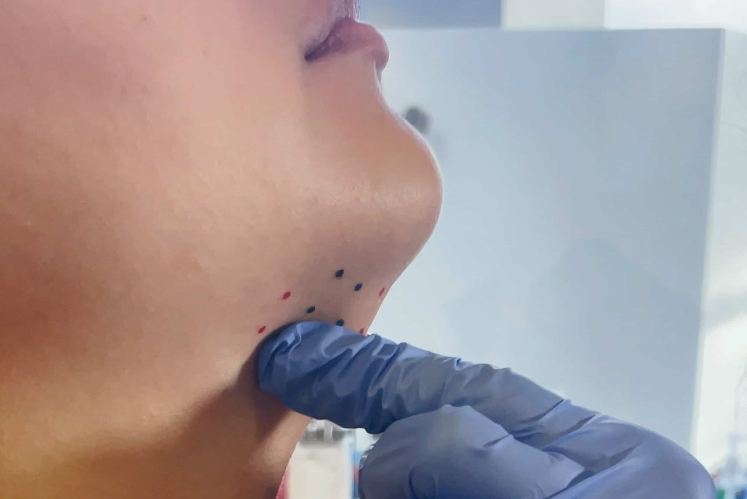 Kybella Injection Mapping