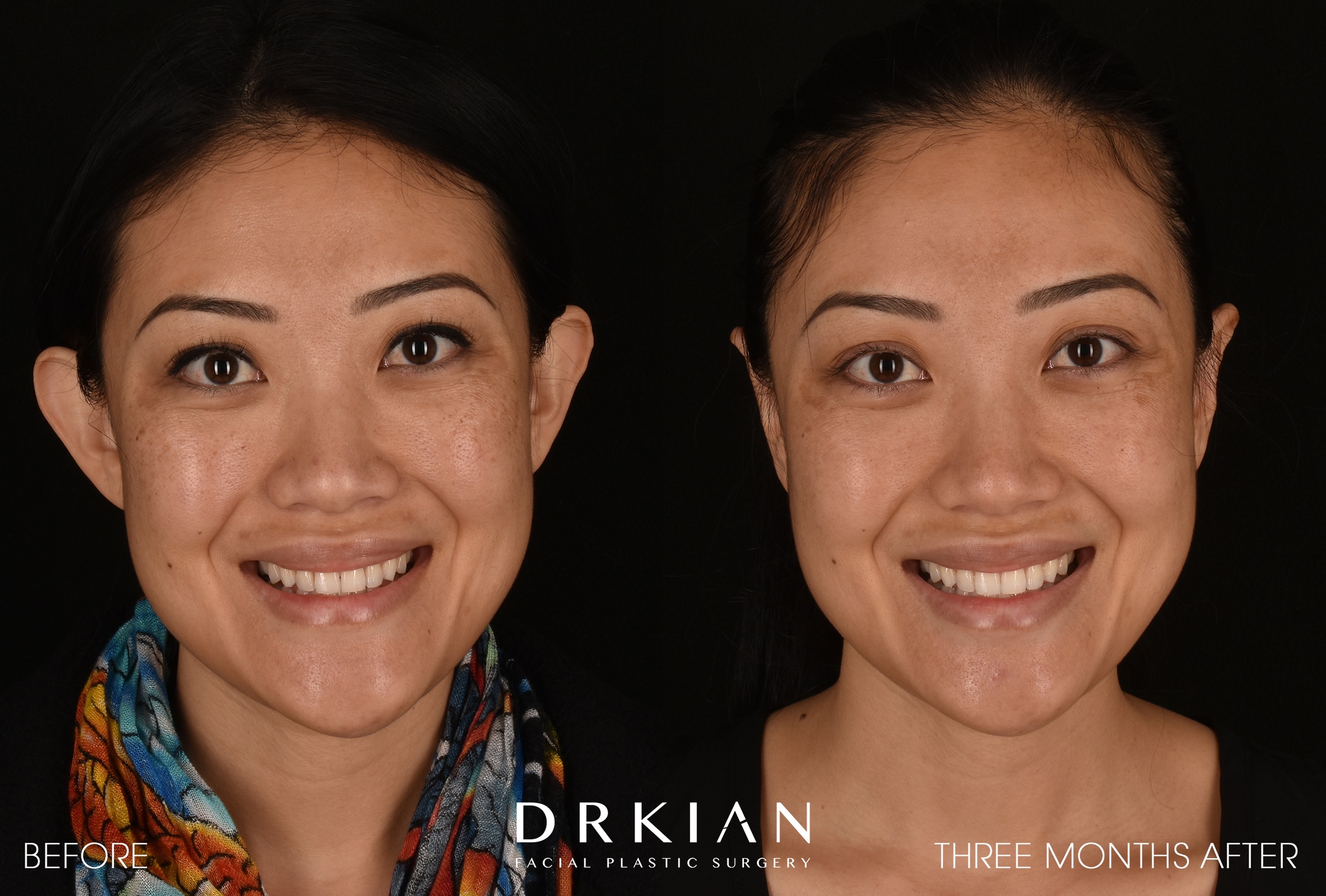 Otoplasty Before & After 3 Months