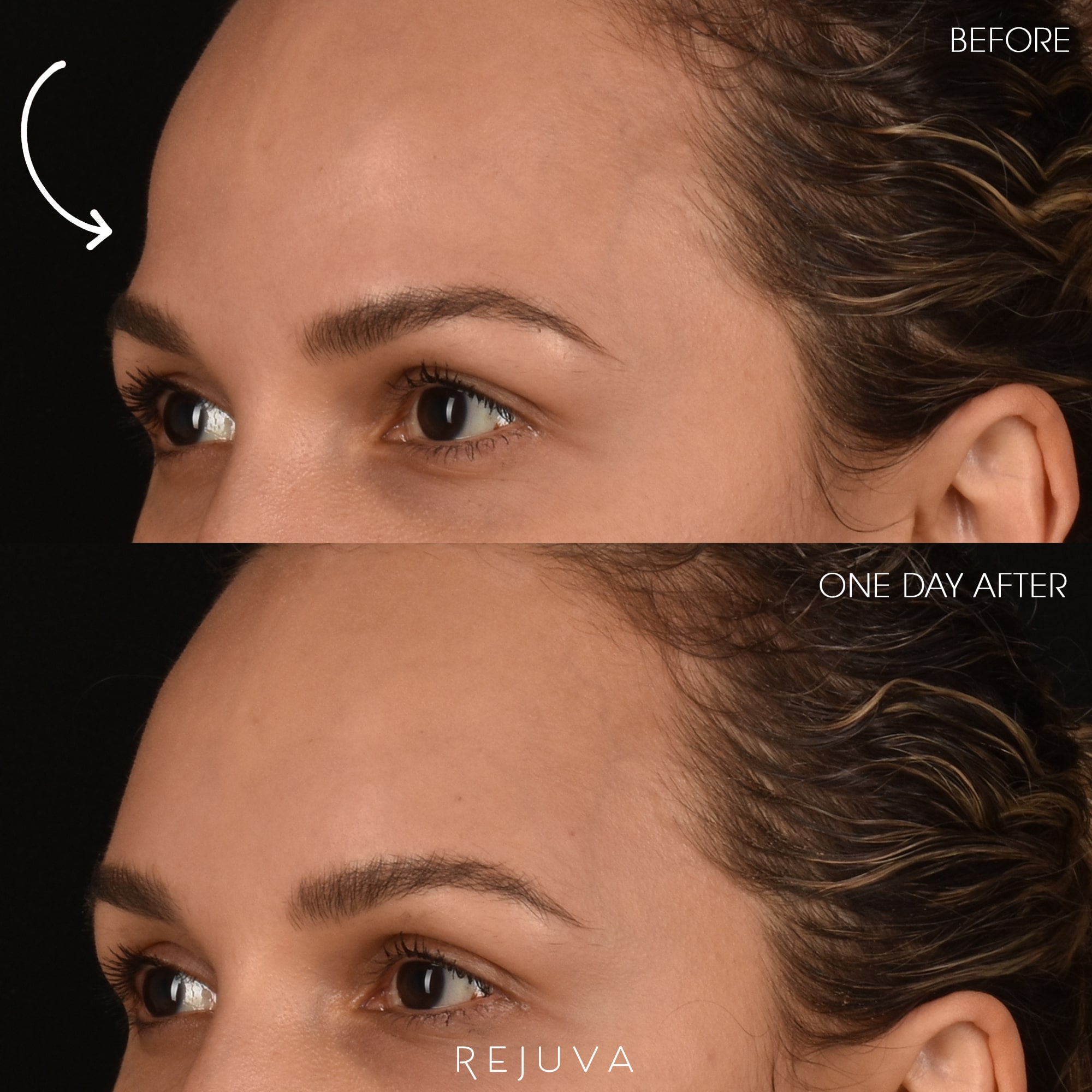 Temple Filler - Rejuva Medical Aesthetics