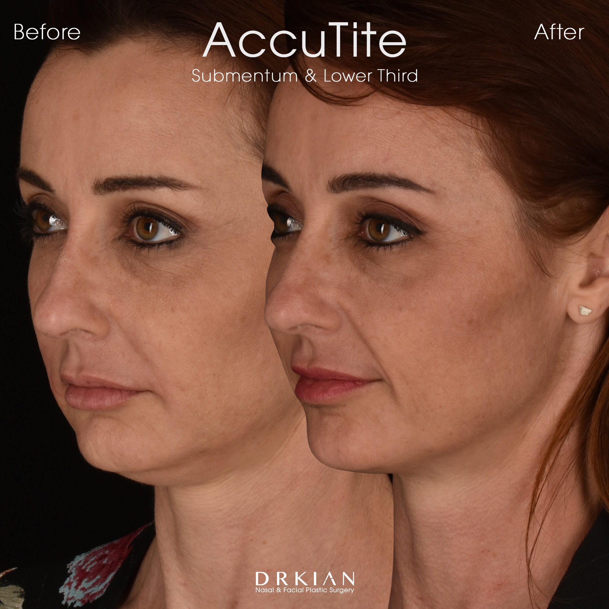 AccuTite Before & After