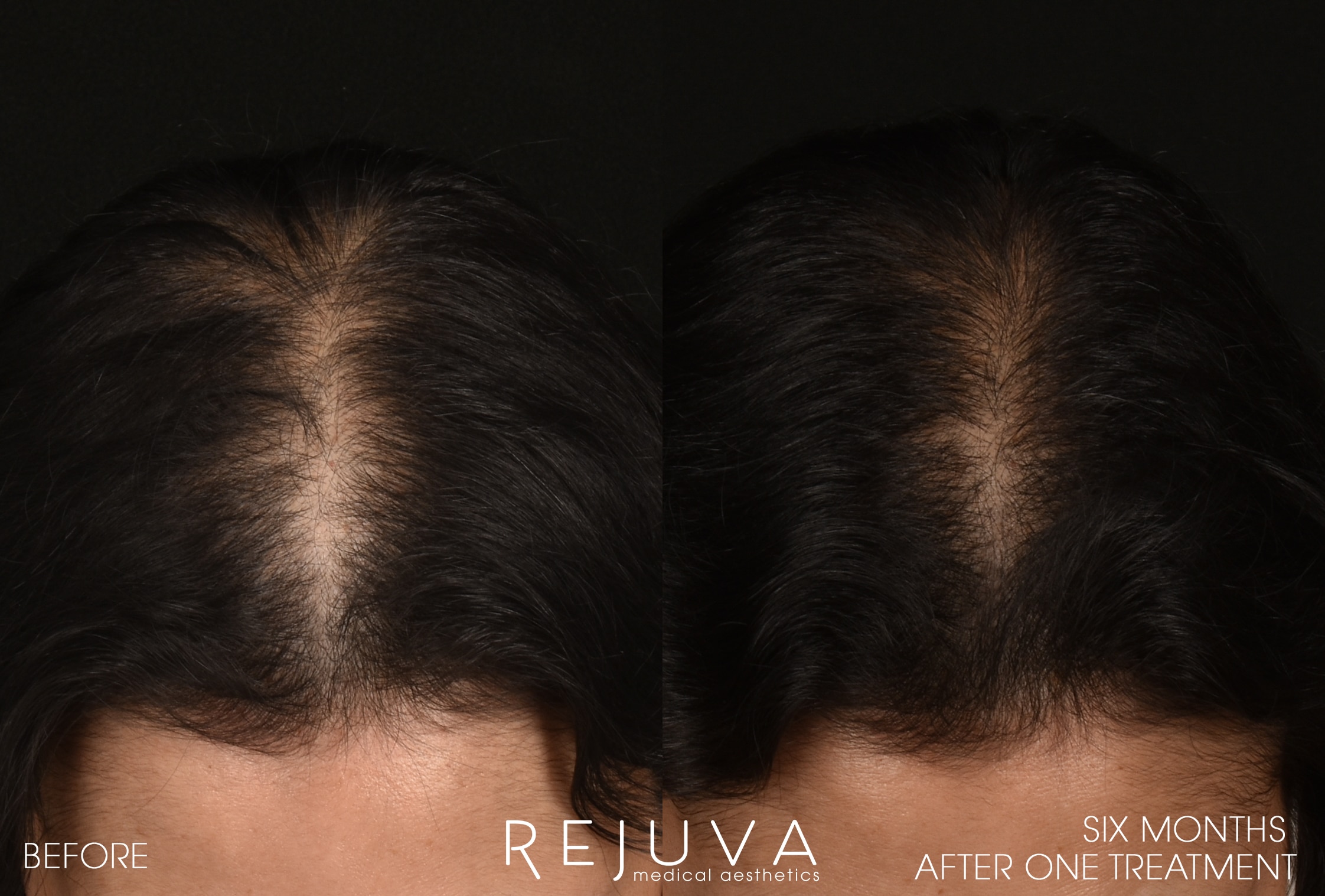 Hair Restoration Before & After