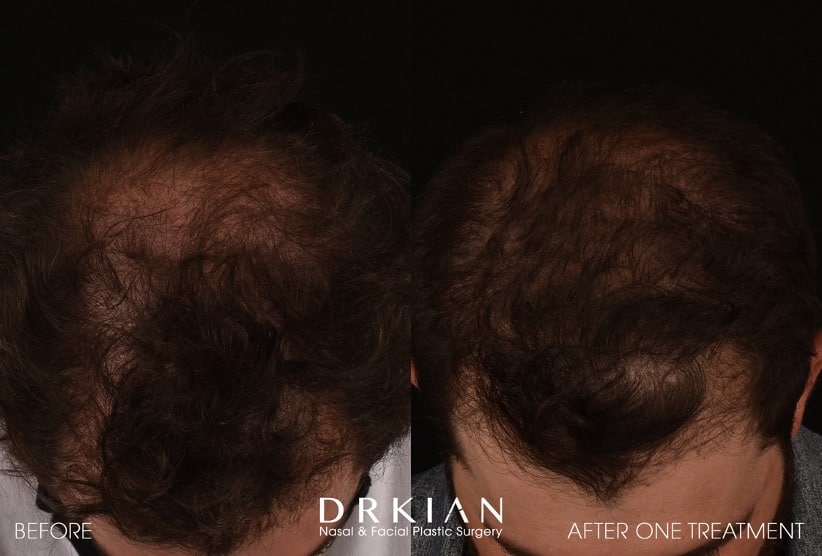 Hair Restoration - PRF