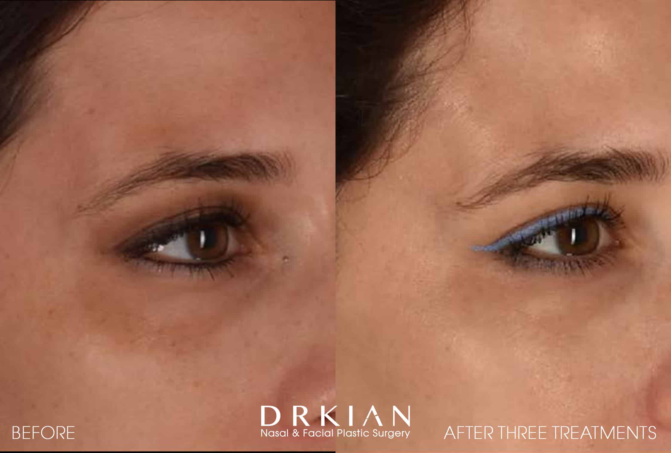 PicoSure Before & After